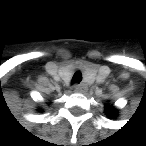 Carotid body tumor (paraganglioma) (Radiopaedia 38586-40729 A 28).jpg