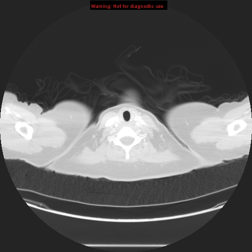 Carotid body tumor with lung metastases (Radiopaedia 9301-48390 Axial lung window 4).jpg