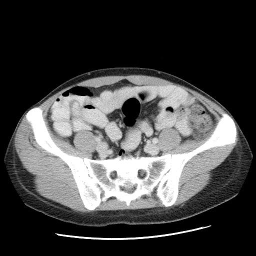 Castleman disease with fibrous pseudotumor in the abdomen (Radiopaedia 77296-89373 A 92).jpg