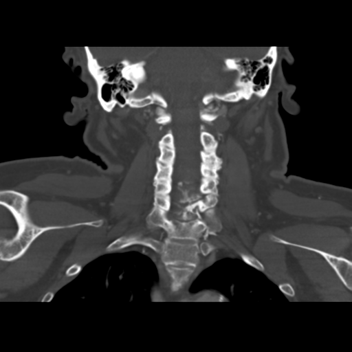 Causes of dysphagia (Radiopaedia 40149-42657 Axial bone window 1).png