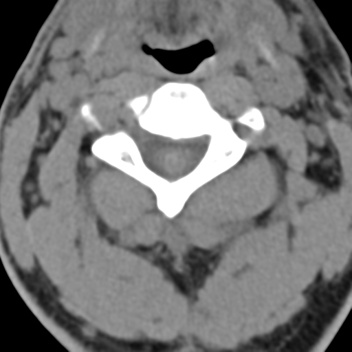 File:Cavernoma of cervical cord (Radiopaedia 50838-56346 Coronal non-contrast 6).png
