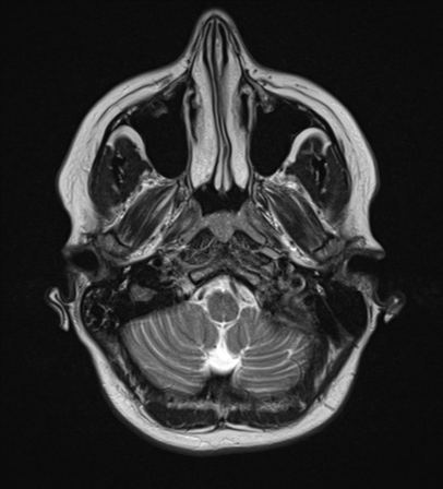 File:Cavernoma with bleed - midbrain (Radiopaedia 54546-60774 Axial T2 3).png
