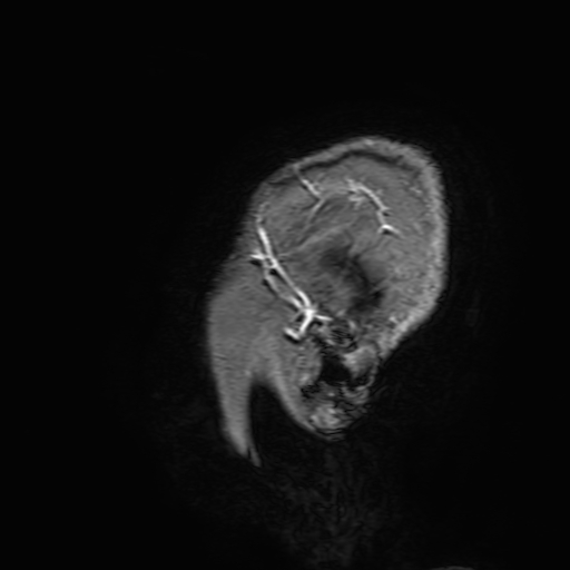 Cavernous hemangioma of the cerebellar falx (Radiopaedia 73025-83724 Sagittal T1 C+ 209).jpg