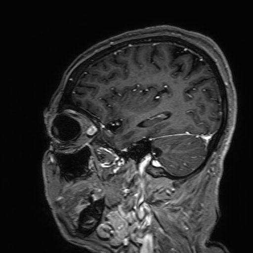 Cavernous hemangioma of the cerebellar falx (Radiopaedia 73025-83724 Sagittal T1 C+ 55).jpg