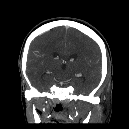 File:Cavernous sinus thrombosis (Radiopaedia 10619-11078 D 16).jpg