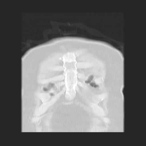 File:Cavitating pulmonary metastases (Radiopaedia 89545-106544 Coronal lung window 3).jpg
