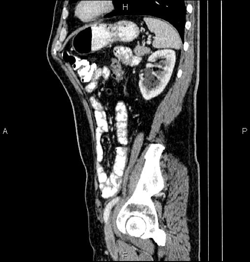 Cecal adenocarcinoma (Radiopaedia 85324-100916 E 69).jpg