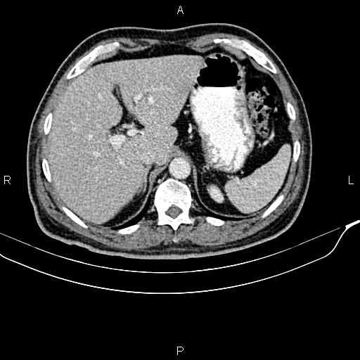 File:Cecal cancer with appendiceal mucocele (Radiopaedia 91080-108651 B 25).jpg