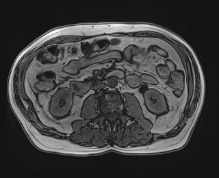 Cecal mass causing appendicitis (Radiopaedia 59207-66532 D 69).jpg