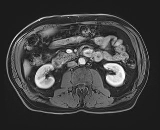 Cecal mass causing appendicitis (Radiopaedia 59207-66532 T1 C+ PV phase 65).jpg
