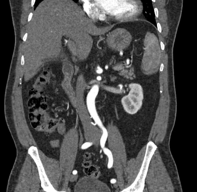 Celiac artery dissection (Radiopaedia 52194-58080 C 56).jpg