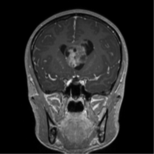 Central neurocytoma (Radiopaedia 37664-39557 Coronal T1 C+ 55).png
