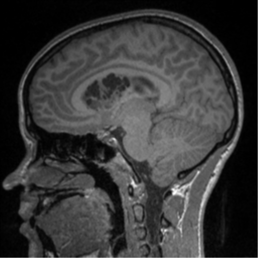 Central neurocytoma (Radiopaedia 37664-39557 Sagittal T1 54).png