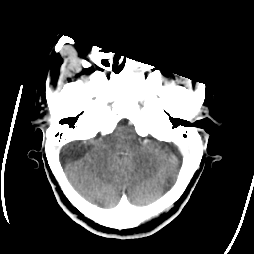 Central neurocytoma (Radiopaedia 65317-74346 Axial C+ delayed 11).png
