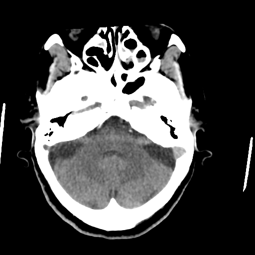 Central neurocytoma (Radiopaedia 65317-74346 Axial non-contrast 12).png