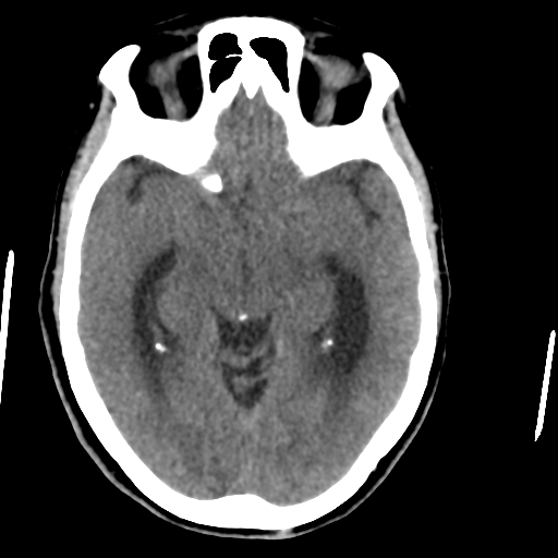 File:Central neurocytoma (Radiopaedia 65317-74346 Axial non-contrast 21).png