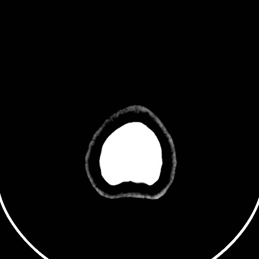 Central neurocytoma (Radiopaedia 84497-99871 Axial non-contrast 55).jpg
