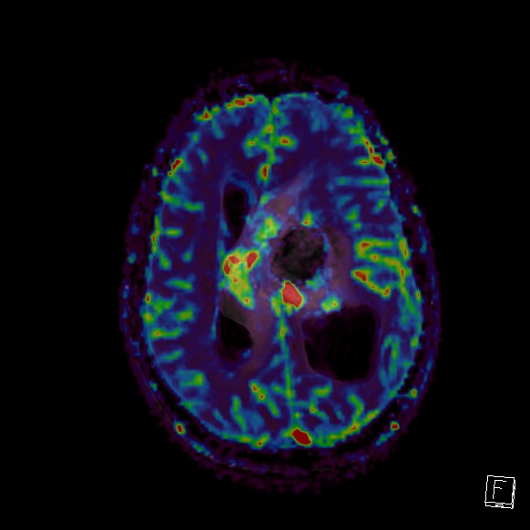 Central neurocytoma (Radiopaedia 84497-99872 Axial Perfusion 122).jpg
