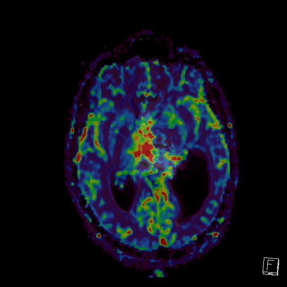 Central neurocytoma (Radiopaedia 84497-99872 Axial Perfusion 166).jpg