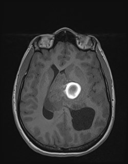 Central neurocytoma (Radiopaedia 84497-99872 Axial T1 113).jpg