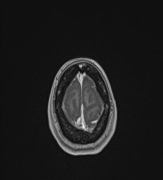 Central neurocytoma (Radiopaedia 84497-99872 Axial T1 C+ 140).jpg