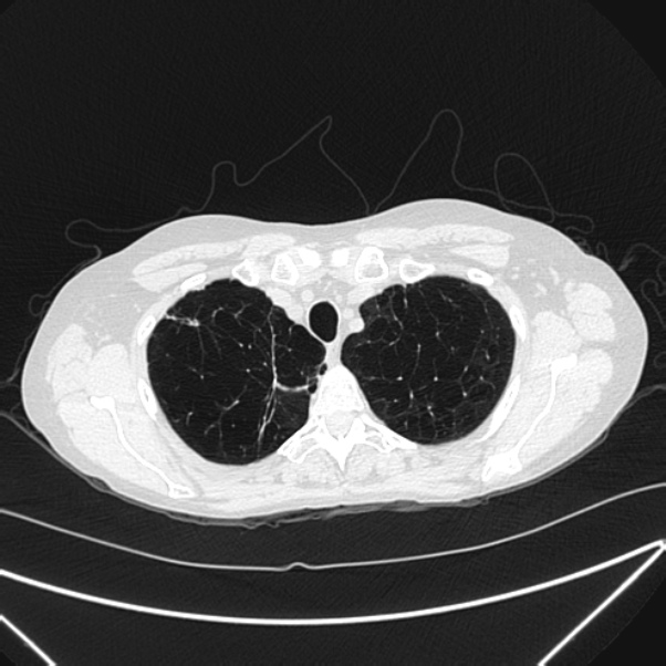 Centrilobular pulmonary emphysema (Radiopaedia 24495-24789 Axial lung window 14).jpg