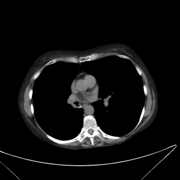 Centrilobular pulmonary emphysema (Radiopaedia 24495-24789 Axial non-contrast 26).jpg