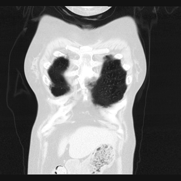 Centrilobular pulmonary emphysema (Radiopaedia 24495-24789 Coronal lung window 6).jpg