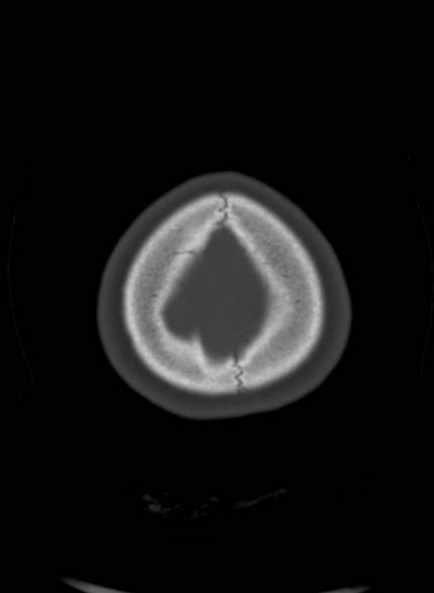 Cerebellar abscess (Radiopaedia 73727-84527 Axial bone window 61).jpg
