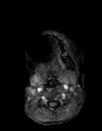 Cerebellar abscess (Radiopaedia 73727-84563 Axial T1 C+ fat sat 6).jpg