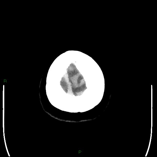 Cerebellar abscess (Radiopaedia 78135-90671 Axial non-contrast 108).jpg