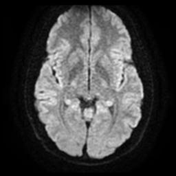 Cerebellar hemangioblastoma (Radiopaedia 29570-30077 Axial DWI 13).jpg