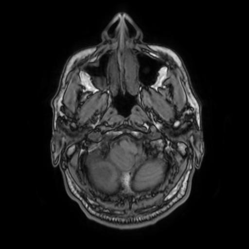 File:Cerebellar hemangioblastoma (Radiopaedia 88055-104622 Axial T1 7).jpg