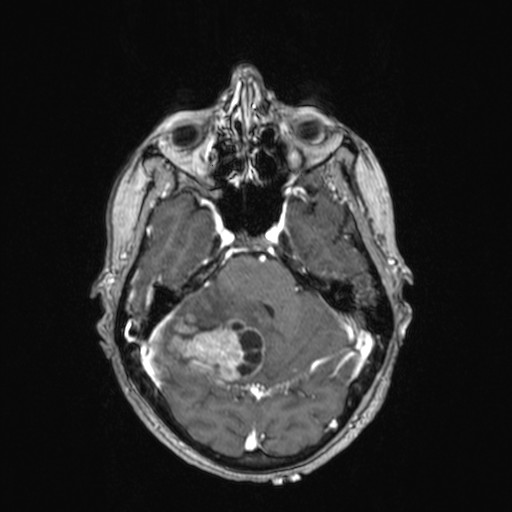 Cerebellar metastases (Radiopaedia 24038-24249 Axial T1 C+ 33).jpg