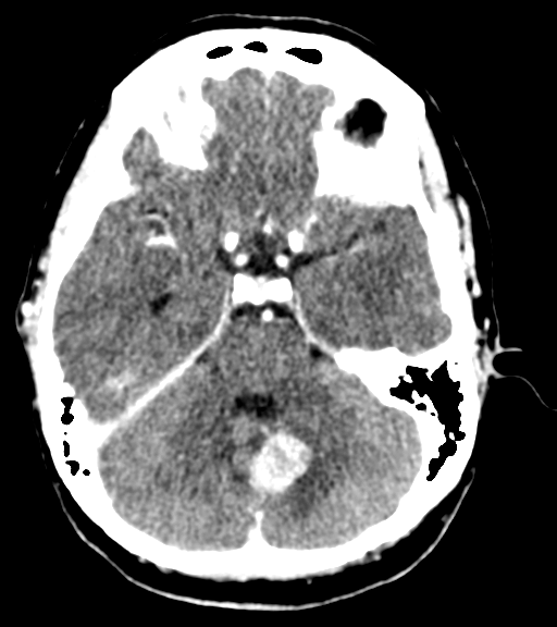Cerebellar metastases - colorectal adenocarcinoma (Radiopaedia 40947-43652 Axial C+ 16).png