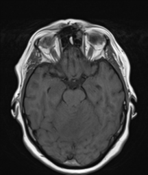 File:Cerebellar metastasis (Radiopaedia 54578-60810 Axial T1 14).png