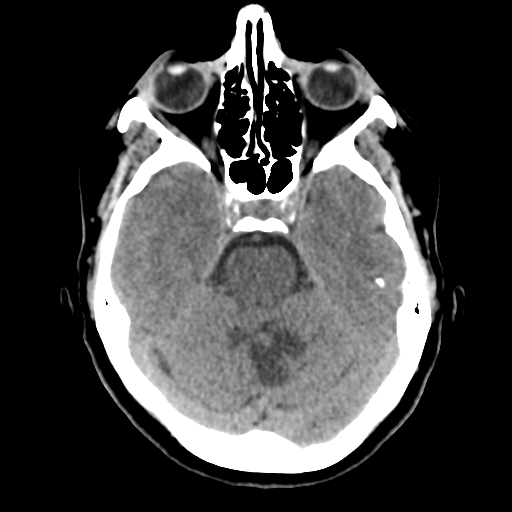 Cerebellar metastasis (cystic appearance) (Radiopaedia 41395-44258 Axial non-contrast 19).png