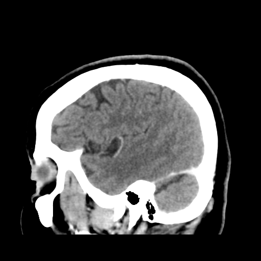 Cerebellar metastasis (cystic appearance) (Radiopaedia 41395-44258 F 13).png