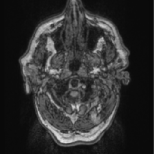 Cerebellar metastasis from lung adenocarcinoma (Radiopaedia 86690-102829 Axial T1 4).png
