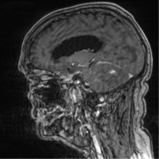 Cerebellar metastasis from lung adenocarcinoma (Radiopaedia 86690-102829 Sagittal T1 C+ 34).png