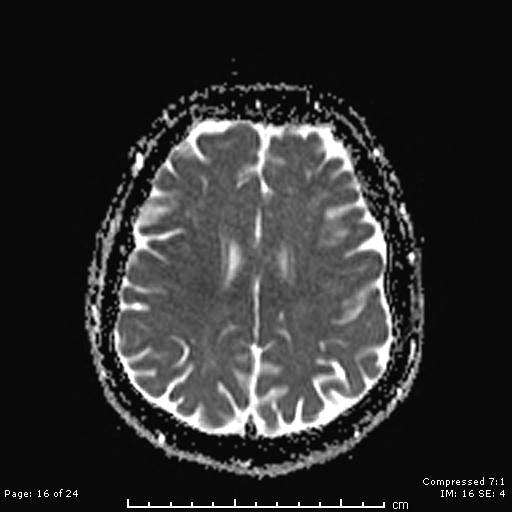 File:Cerebellar strokes due to intracranial giant cell arteritis (Radiopaedia 68799-81713 Axial ADC 16).jpg