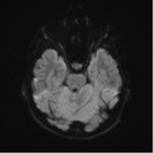 Cerebellar tuberculomas (Radiopaedia 46939-51472 Axial DWI 38).png