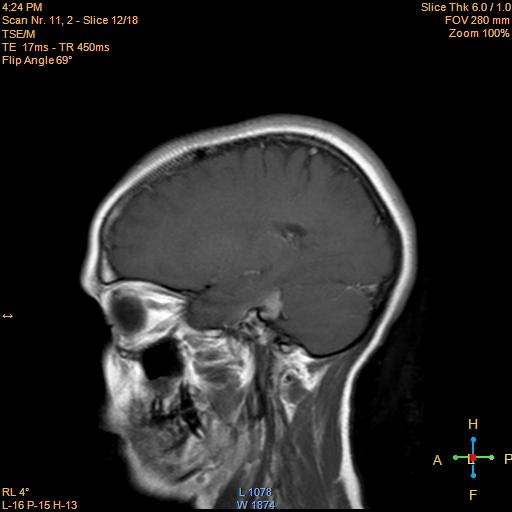 File:Cerebellopontine angle meningioma (Radiopaedia 22488-22525 Sagittal T1 C+ 12).jpg