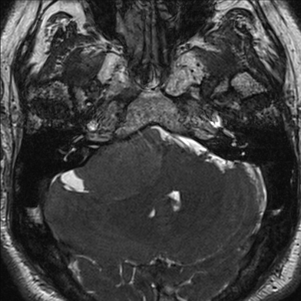 Cerebellopontine angle meningioma (Radiopaedia 24459-24764 I 19).jpg