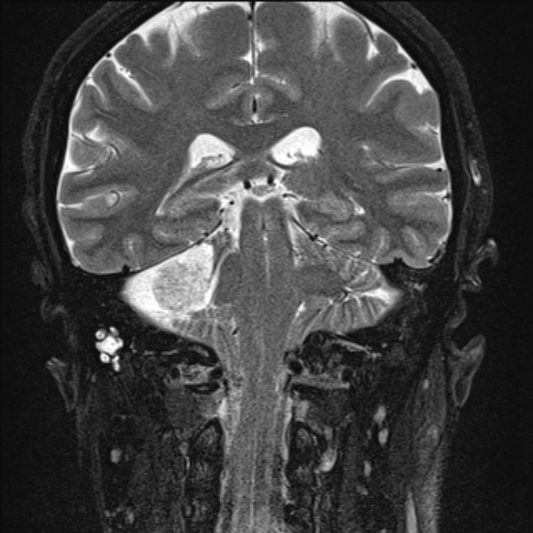 File:Cerebellopontine angle meningioma (Radiopaedia 53561-59591 Coronal T2 17).jpg
