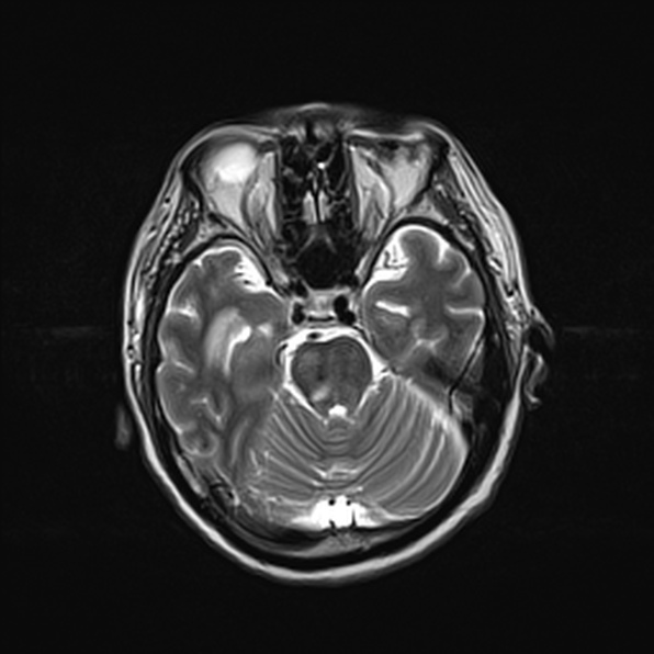 Cerebral abscess (Radiopaedia 26111-26247 Axial T2 24).jpg