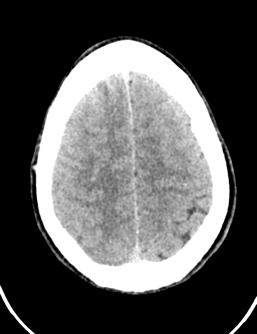 Cerebral abscess (Radiopaedia 60342-68008 Axial non-contrast 42).png