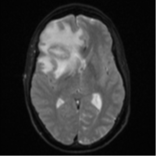 Cerebral abscess (Radiopaedia 60342-68009 Axial DWI 18).png