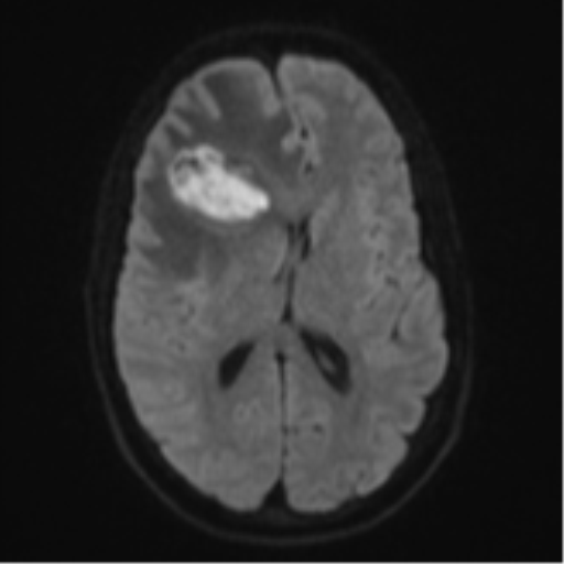 Cerebral abscess (Radiopaedia 60342-68009 Axial DWI 56).png