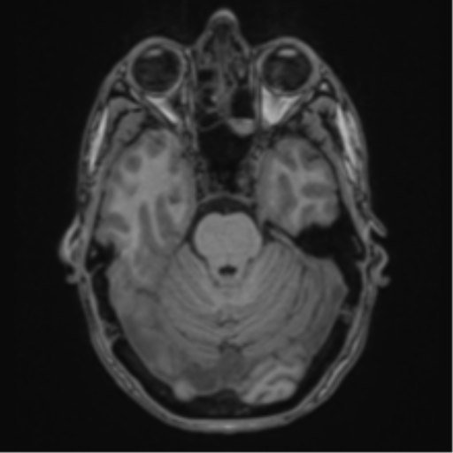 File:Cerebral abscess (Radiopaedia 60342-68009 Axial T1 12).png